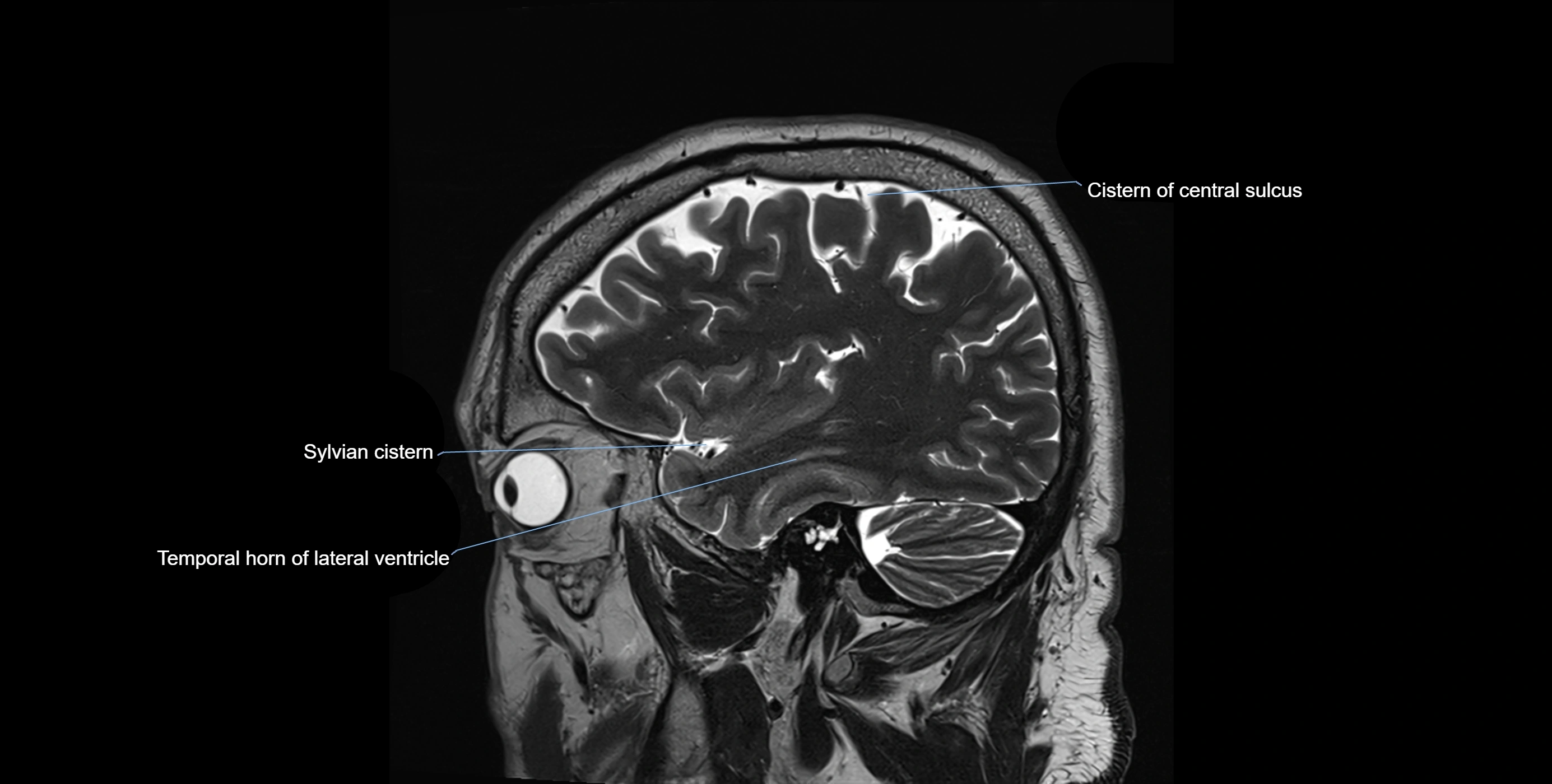Brain cisterns  and ventricles sagittal anatomy 3T MRI image-img-00001-00012.webp